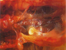 그림 2. 복강내 노란색의 육아종성 결절형성