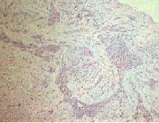 그림 4. 심근세포들 사이에 단핵구성염증세포 침윤